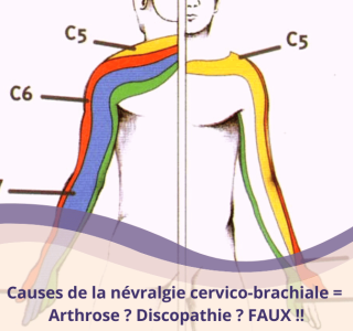 nevralgie cervico brachiale causes